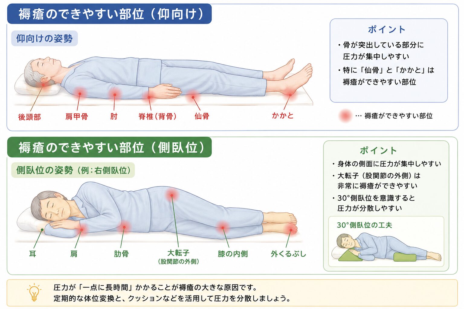 褥瘡ができる5つの原因（圧迫・ずれ・摩擦・湿潤・栄養不良）を示す図