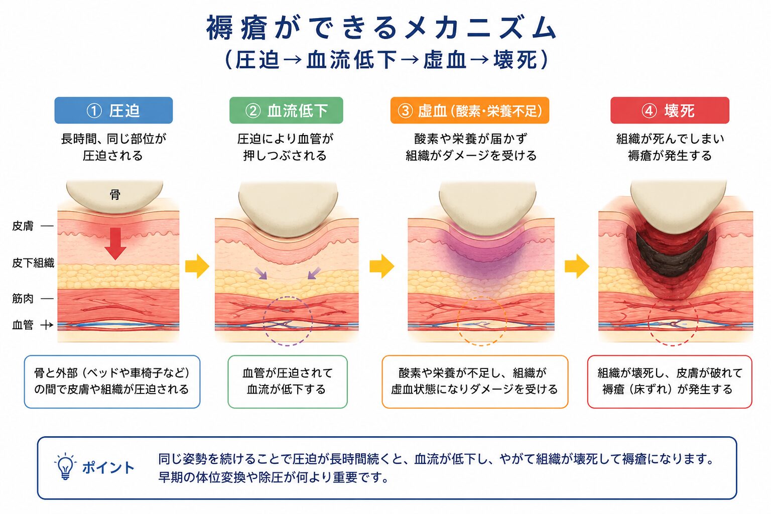 圧迫から褥瘡ができるまでの流れを示す図