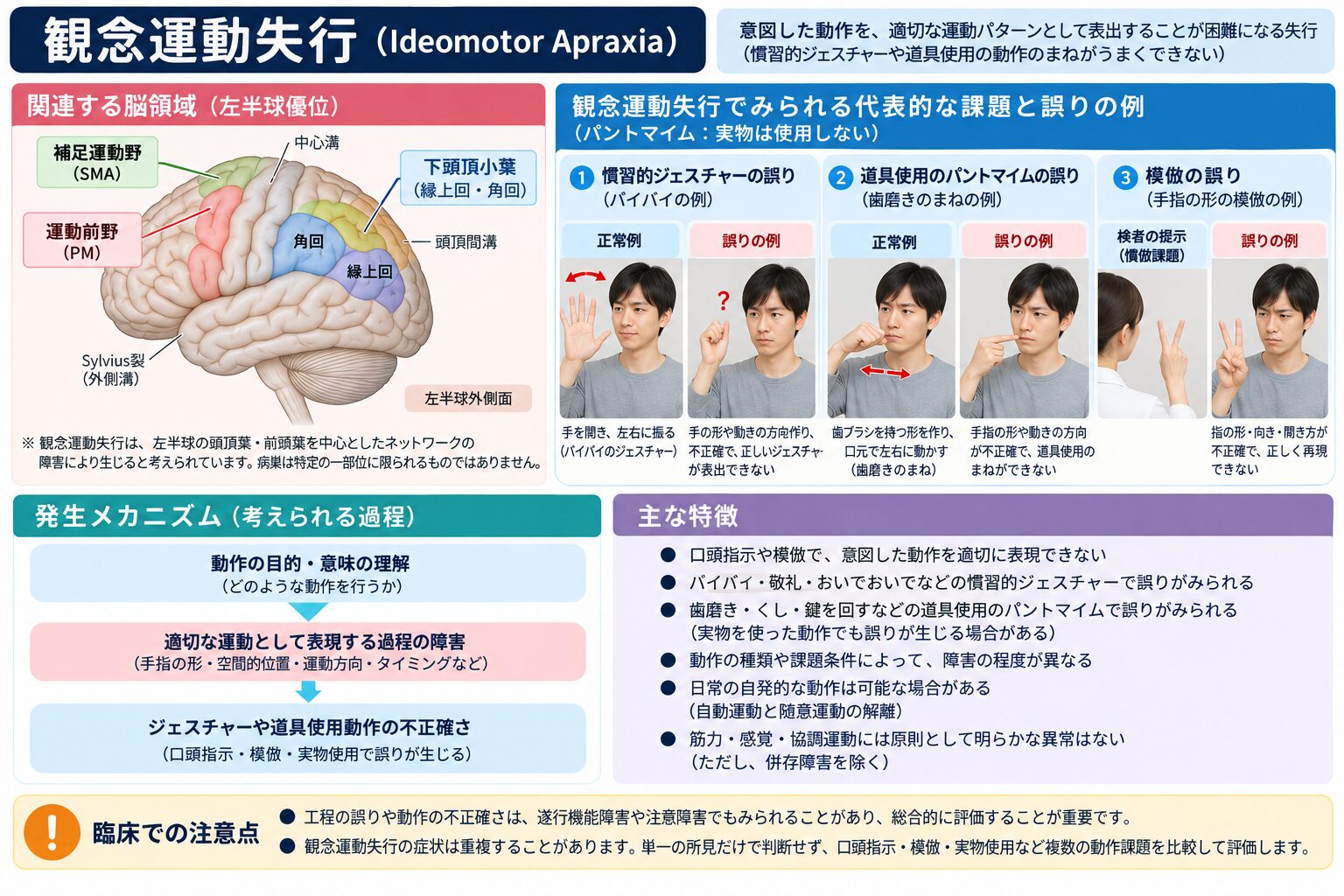 観念運動失行で歯磨きのパントマイムの手の形や動作の方向を誤る例